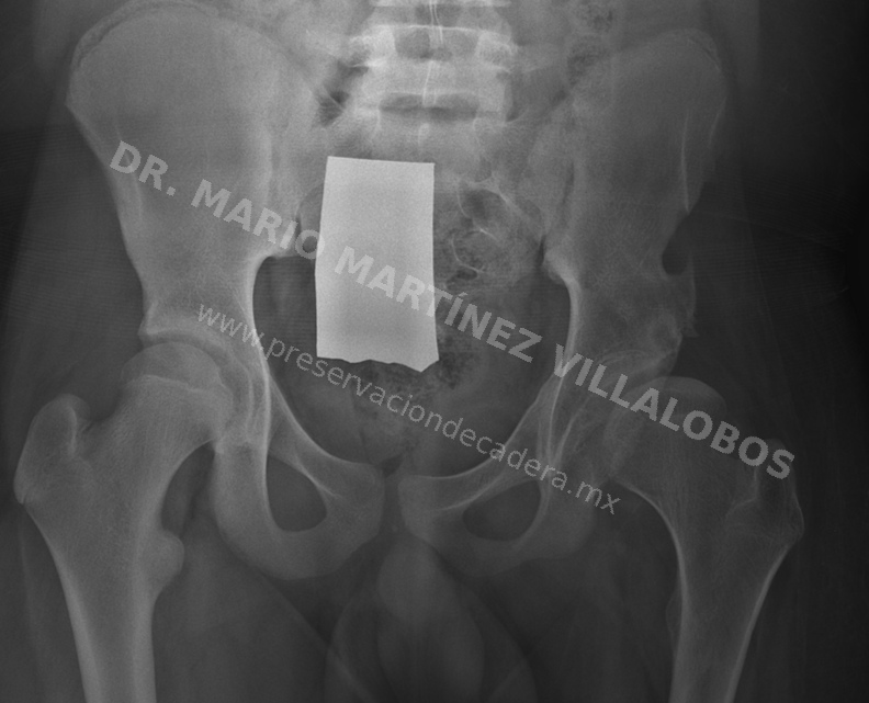 Radiografía preoperatoria de cadera con displasia acetabular